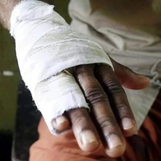 A bandaged hand after treatment