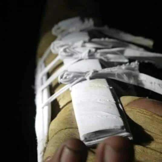 Foot wrapped in traditional bandaging